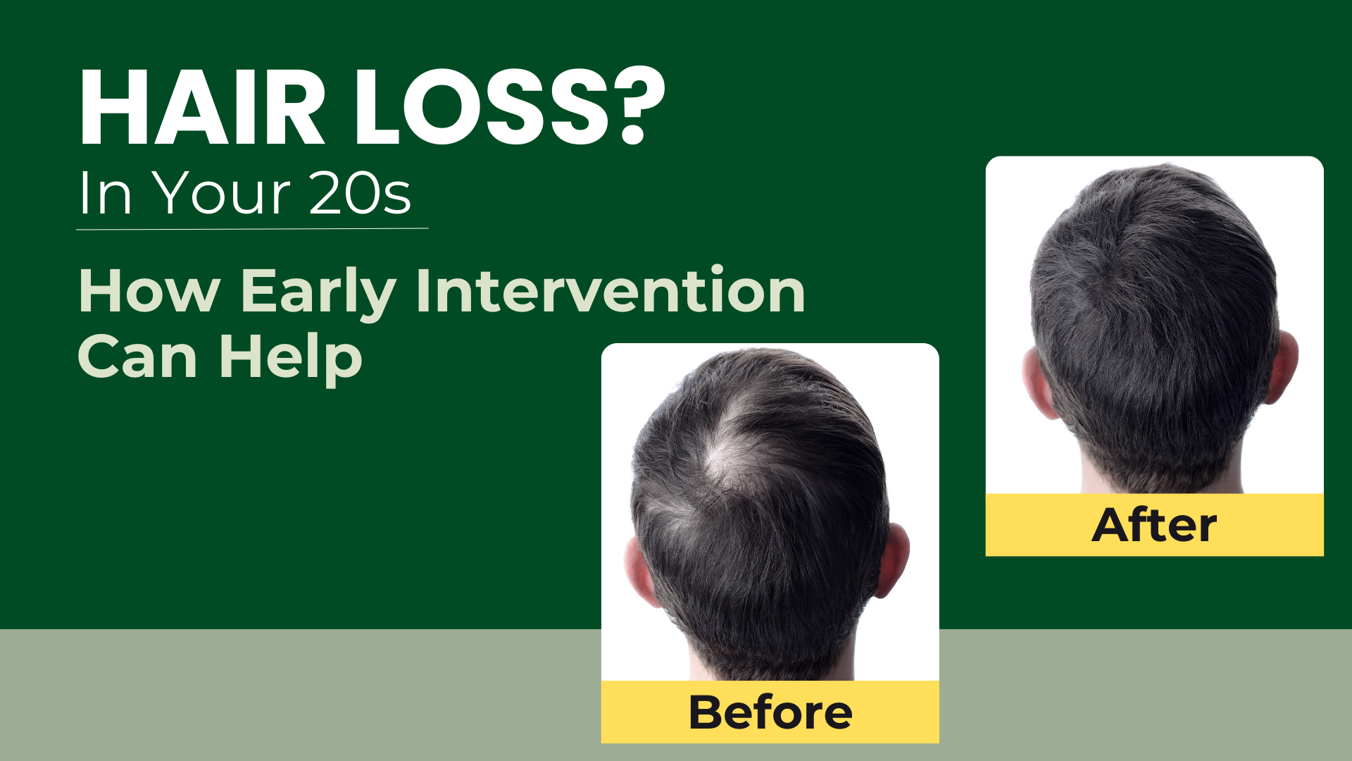Hair Loss in Your 20s? How Early Treatment Can Save Your Hair
