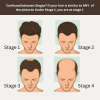Stage 1 : Hair fall solution