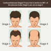 Stage 3 : Hair fall solution
