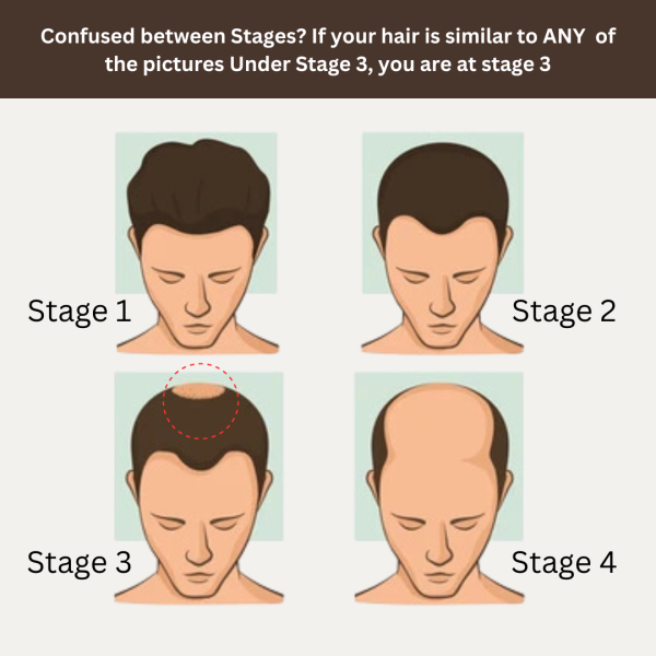 Stage 3 : Hair fall solution