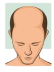 Stage 1 : Hair fall solution