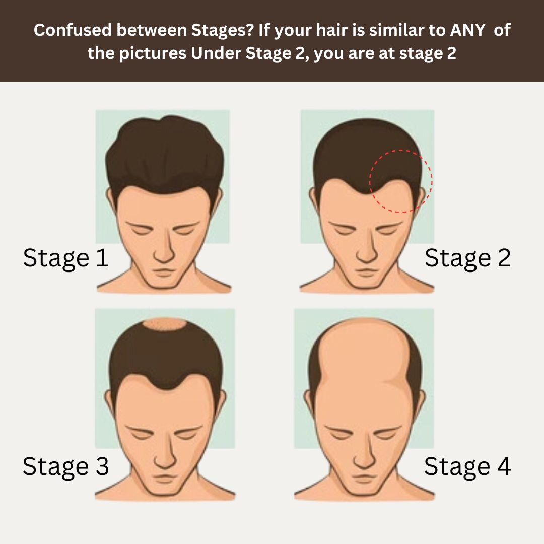 Stage 2 : Hair fall solution