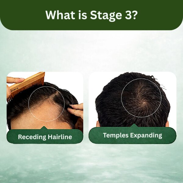 Stage 3 : Hair fall solution