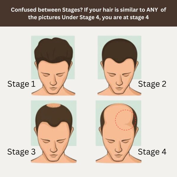 Stage 4 : Hair fall solution