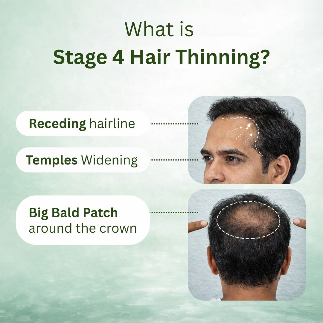 Stage 4 : Hair fall solution
