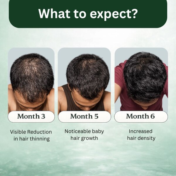 Stage 4 : Hair fall solution