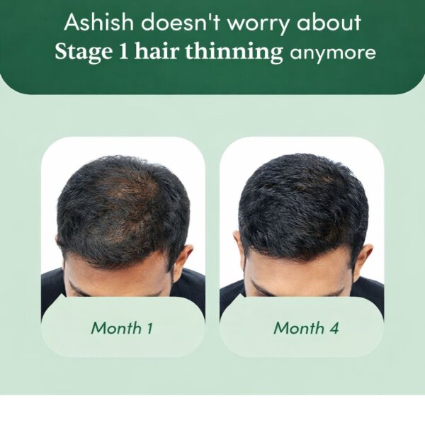 Stage 1 : Hair fall solution