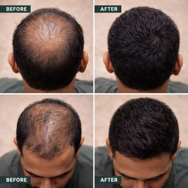 Regrow 5% - Hair Regrowth Spray for Fuller, Thicker Hair