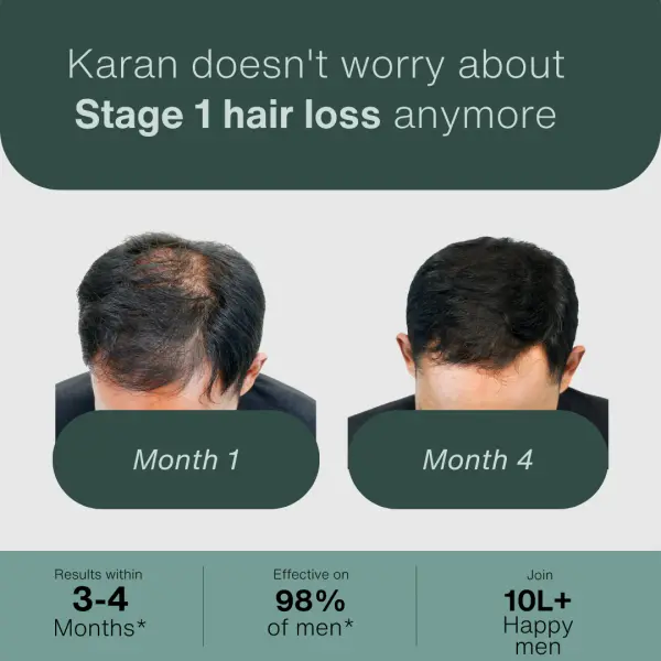 Hair Fall Stage 1: The Starter Kit